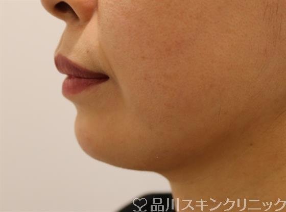 症例NO.44082のAFTER写真