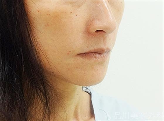 症例NO.30517のAFTER写真