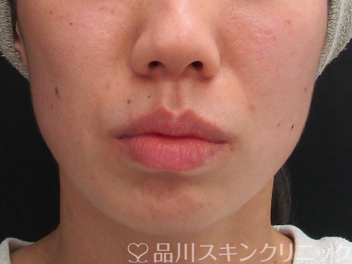 症例NO.72739のBEFORE写真