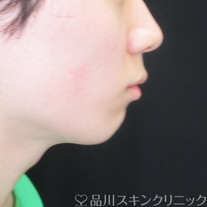 症例NO.73405のBEFORE写真