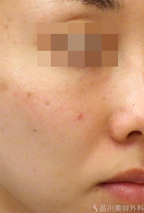 症例NO.27783のBEFORE写真