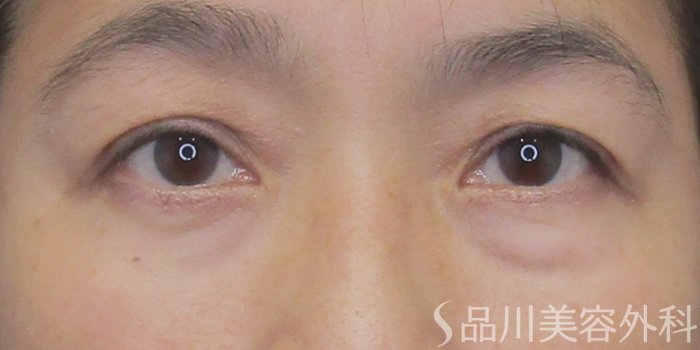 症例NO.75136のAFTER写真