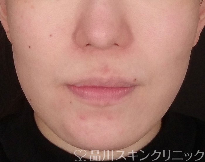 症例NO.69809のBEFORE写真