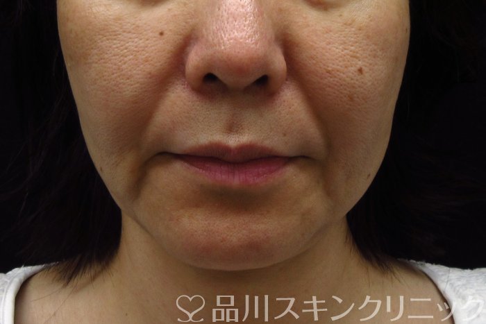 症例NO.74320のBEFORE写真