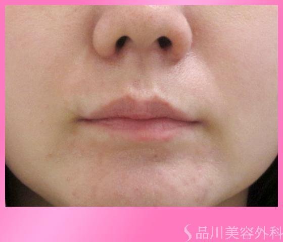 症例NO.1781のBEFORE写真