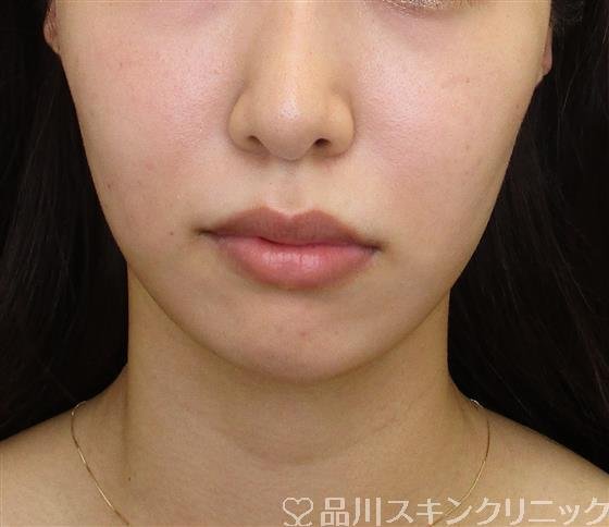 症例NO.58830のAFTER写真
