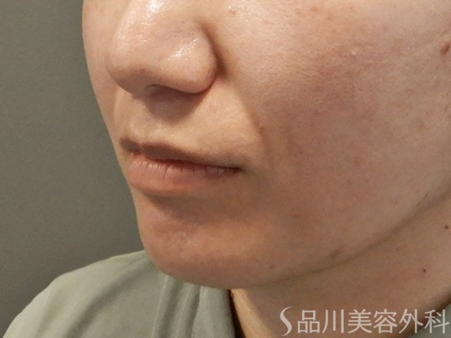 症例NO.73770のBEFORE写真