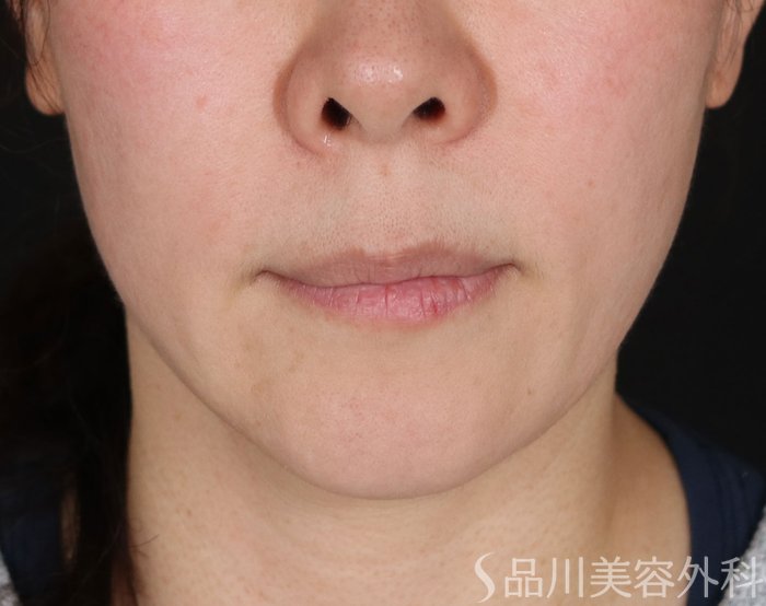 症例NO.72402のBEFORE写真