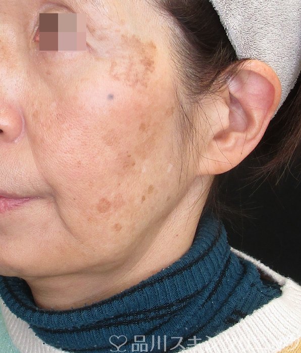 症例NO.73482のAFTER写真