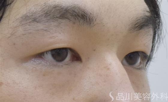 症例NO.52435のBEFORE写真