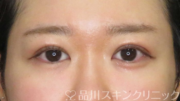 症例NO.73539のAFTER写真