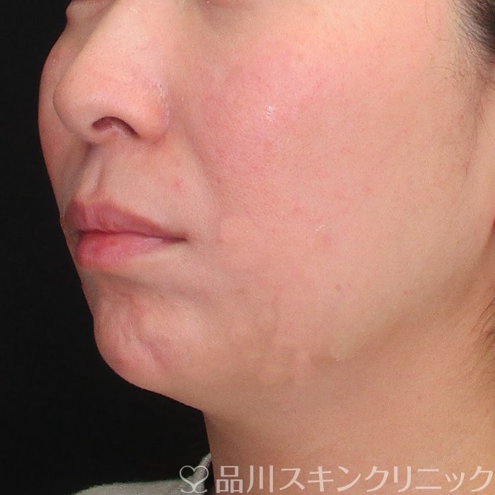 症例NO.73414のAFTER写真