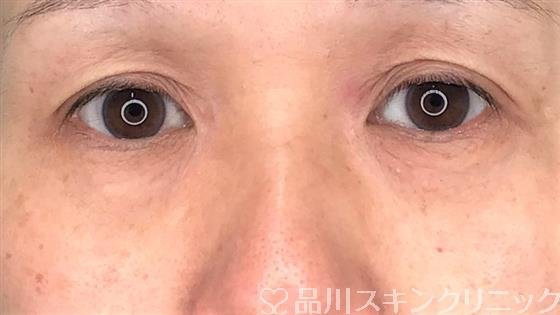 症例NO.60382のBEFORE写真