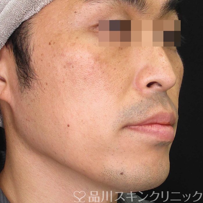 症例NO.70007のBEFORE写真