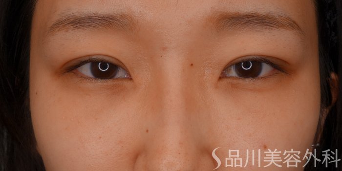 症例NO.74470のAFTER写真