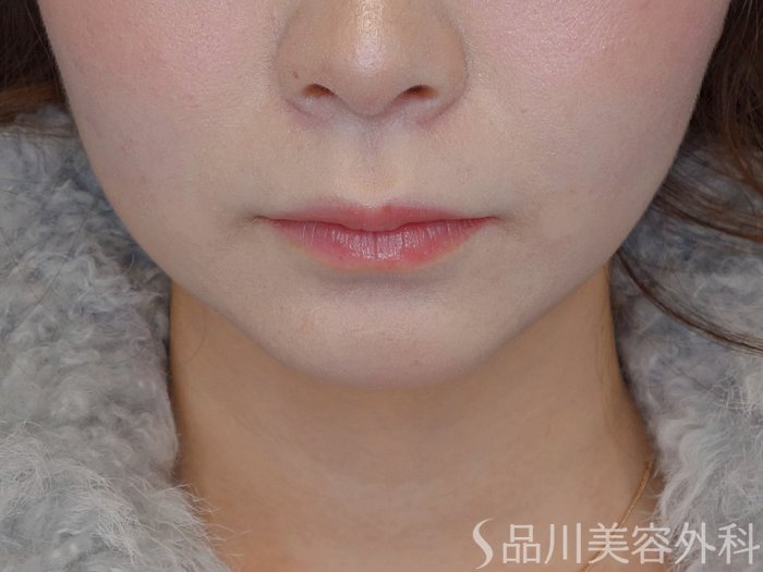 症例NO.72406のBEFORE写真