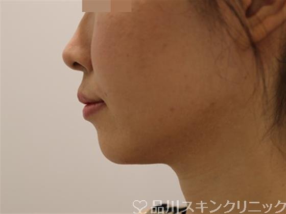症例NO.43255のBEFORE写真