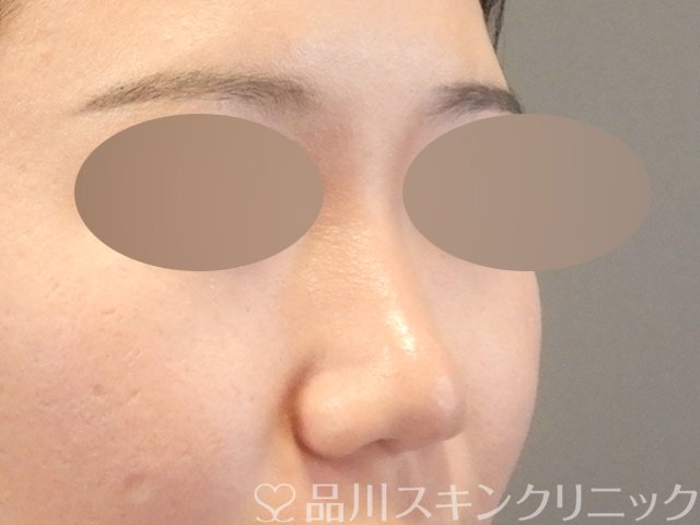 症例NO.65424のAFTER写真