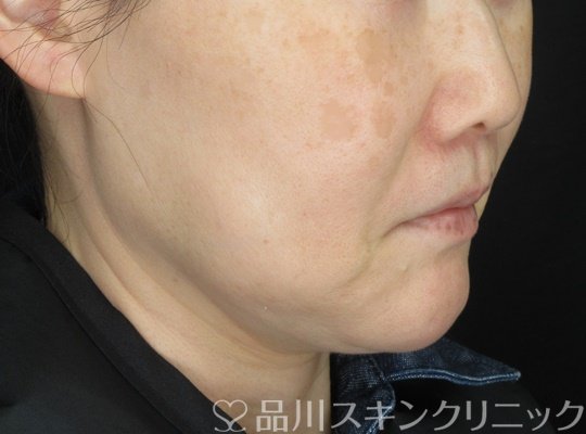 症例NO.70122のBEFORE写真