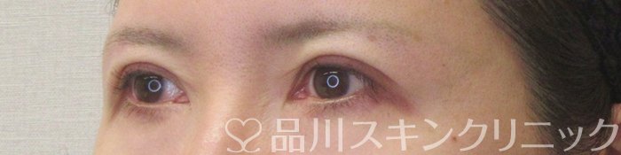 症例NO.71138のAFTER写真