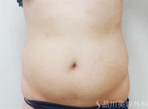 症例NO.23405のAFTER写真