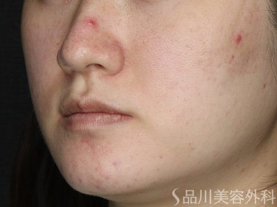 症例NO.73812のBEFORE写真