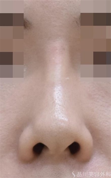 症例NO.44113のAFTER写真