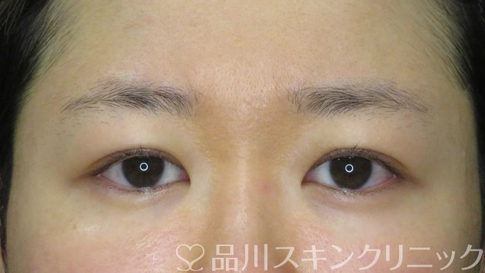 症例NO.73539のBEFORE写真