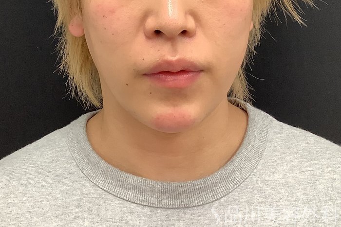 症例NO.75333のAFTER写真