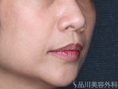 症例NO.74688のAFTER写真