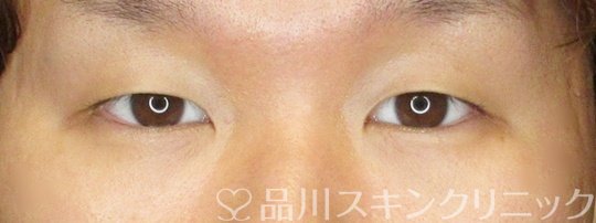 症例NO.70953のBEFORE写真