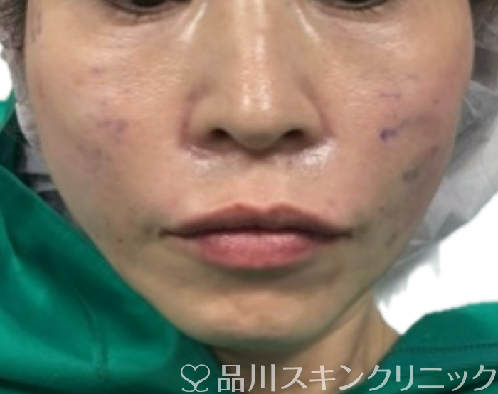 症例NO.71156のAFTER写真