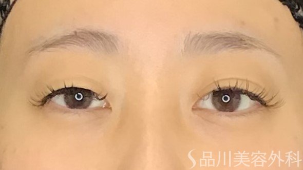 症例NO.69635のBEFORE写真