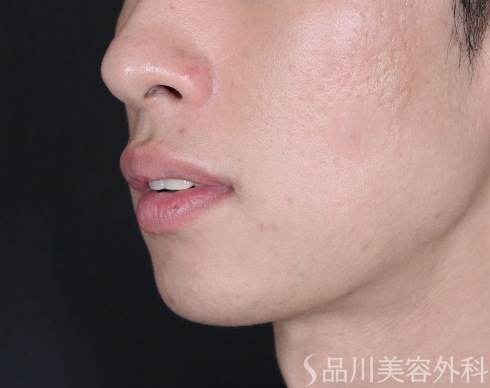 症例NO.70848のBEFORE写真