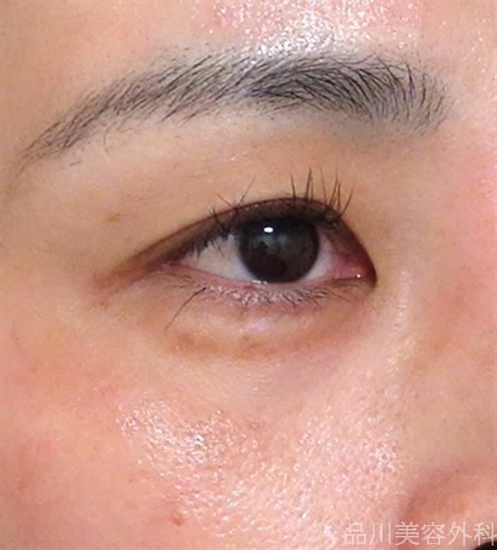 症例NO.27486のBEFORE写真