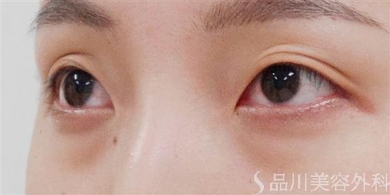 症例NO.34903のBEFORE写真