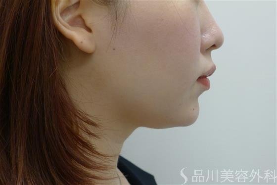 症例NO.61570のAFTER写真