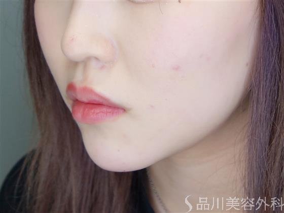 症例NO.51310のAFTER写真