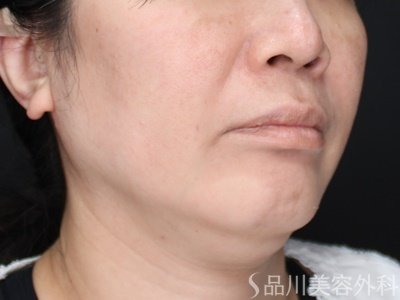 症例NO.71598のBEFORE写真