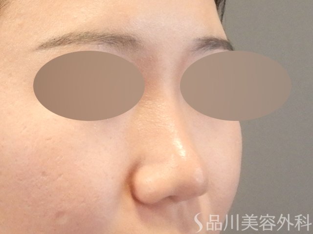 症例NO.65424のAFTER写真