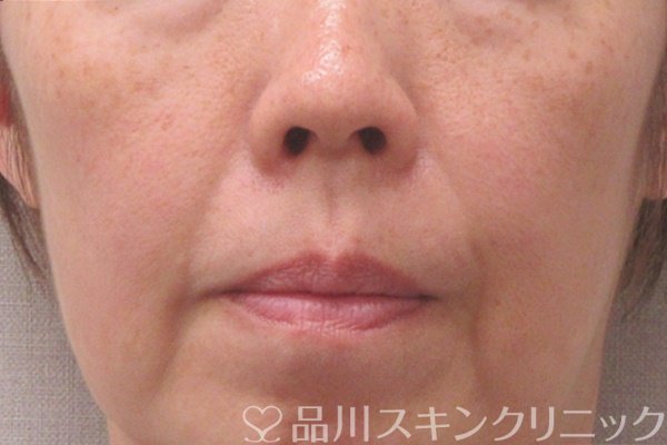 症例NO.73172のBEFORE写真