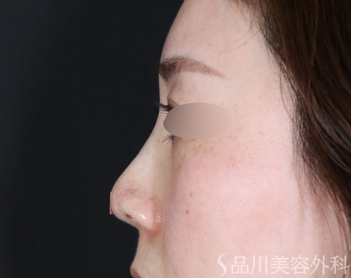 症例NO.72636のAFTER写真