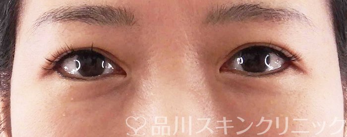 症例NO.67862のBEFORE写真