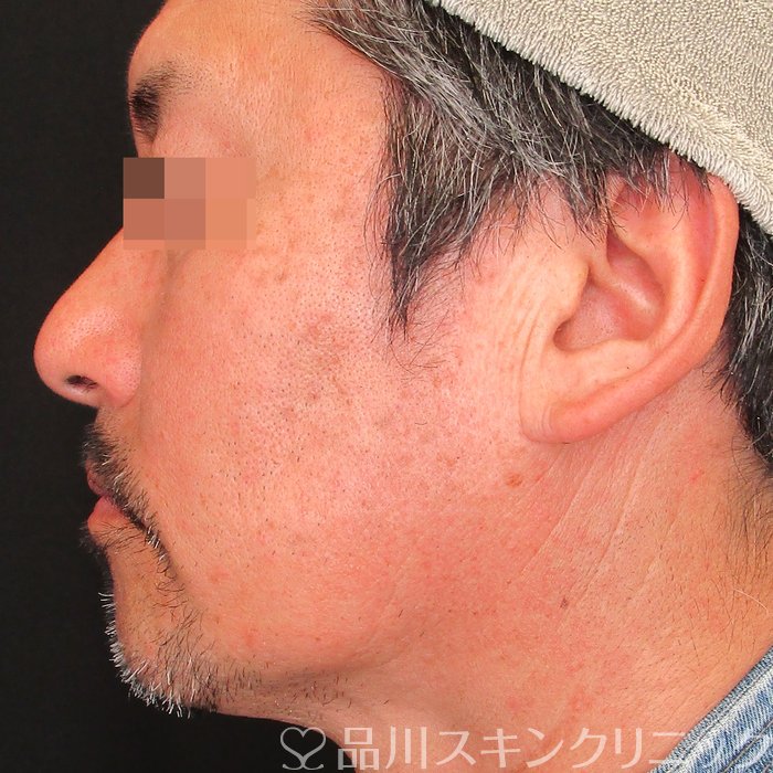 症例NO.73638のAFTER写真