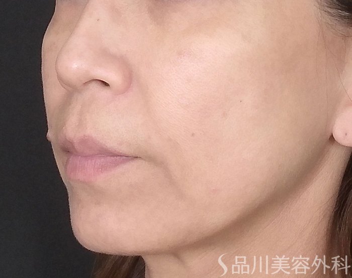 症例NO.70143のBEFORE写真