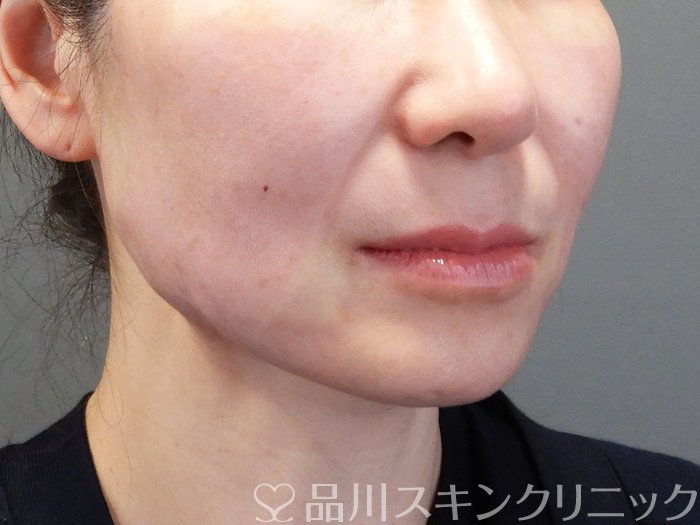 症例NO.74103のAFTER写真