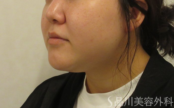 症例NO.71605のBEFORE写真