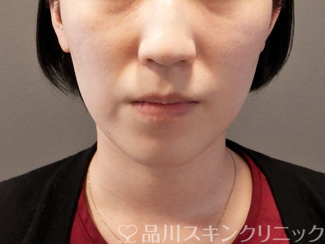 症例NO.67417のBEFORE写真