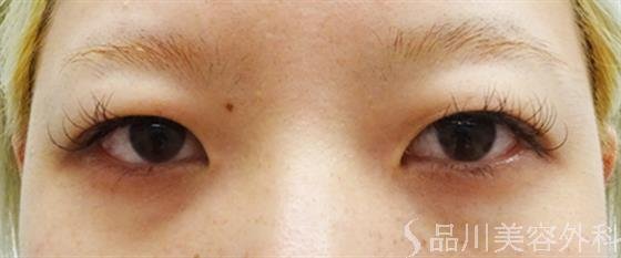 症例NO.49145のBEFORE写真