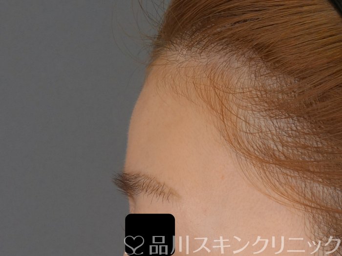 症例NO.72318のBEFORE写真